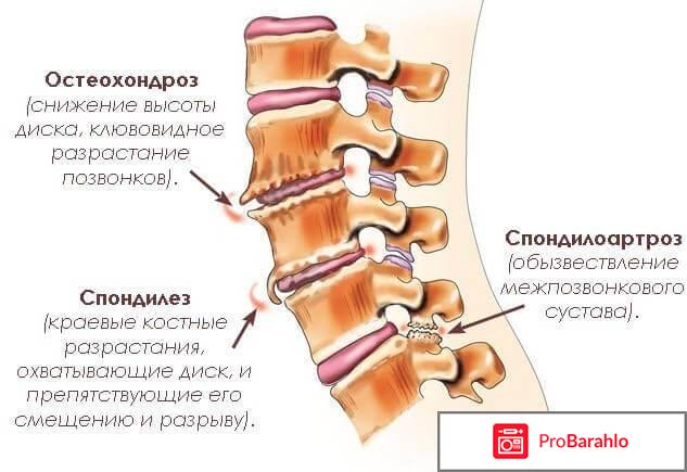 Чем опасен спондилез обман