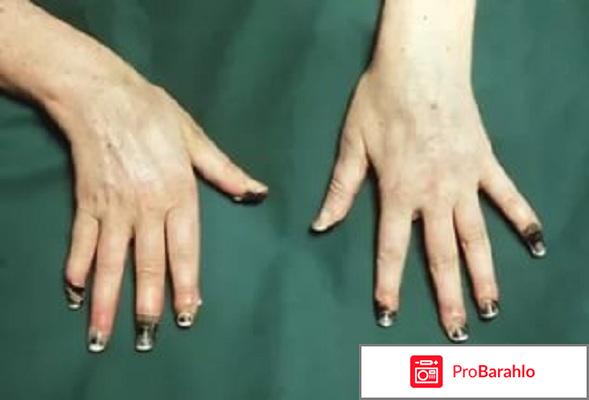 Синдром Рейно: причины, стадии, симптомы, лечение обман