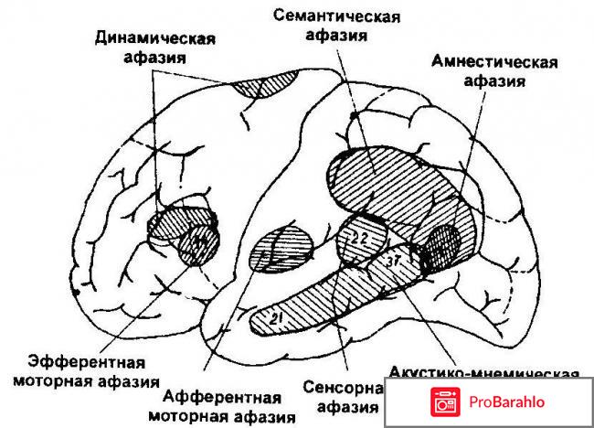 Афазия у человека: причины, виды, лечение отрицательные отзывы