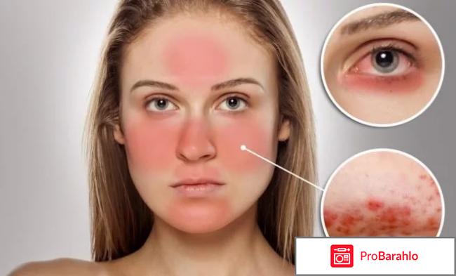 Причины появления сосудистых звездочек на лице 