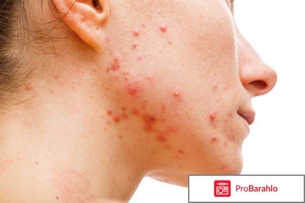 Аверсектиновая мазь от демодекоза у людей отзывы отрицательные отзывы