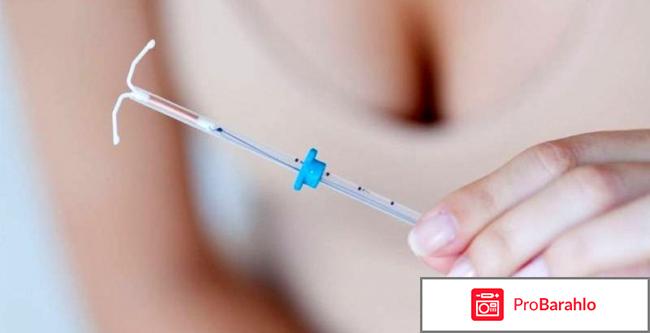 Мирена отзывы женщин после 50 