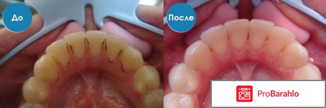 Ультразвуковая очистка зубов отрицательные отзывы