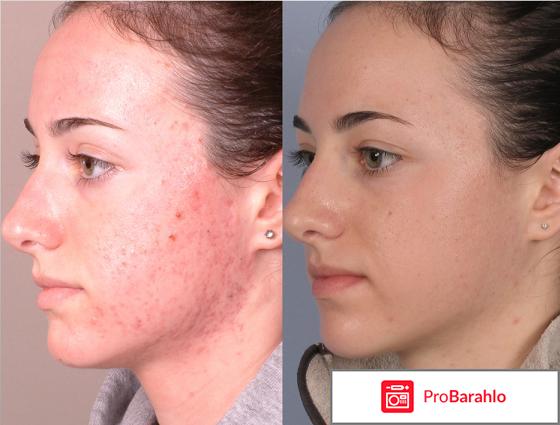 Аверсектиновая мазь от демодекоза у людей отзывы обман