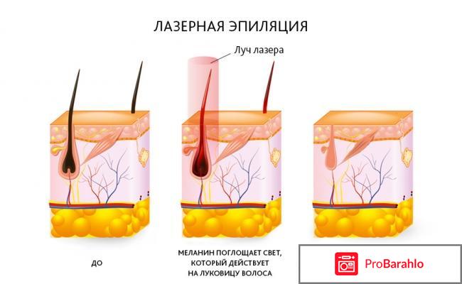 Отзывы лазерная эпиляция отрицательные отзывы