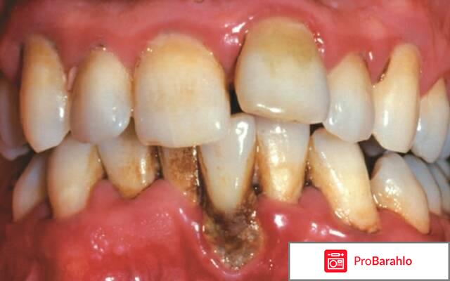 Как лечится пародонтоз 