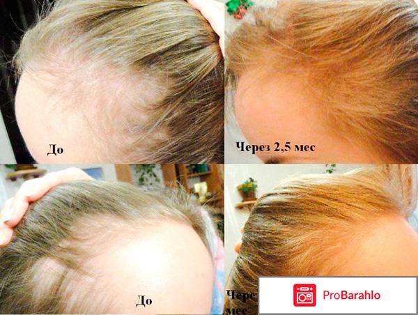 Шампунь алерана для роста отзывы фото