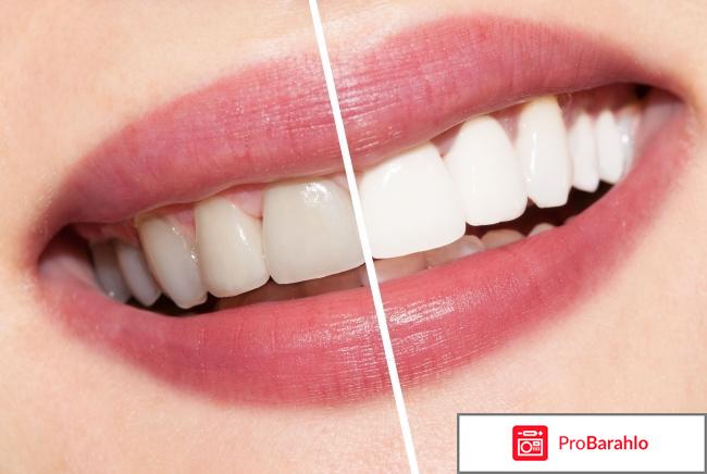 Сколько стоит отбеливание 