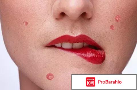 Крем против прыщей 