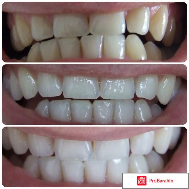 Полоски для отбеливания зубов 3d white отрицательные отзывы