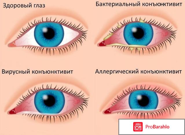 Лечение коньюктивита в домашних условиях у взрослых обман