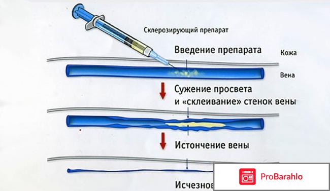 Склеротерапия вен нижних конечностей отзывы фото отрицательные отзывы