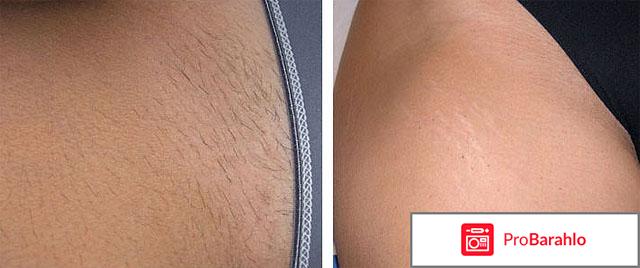 Aloe Epil - крем для депиляции реальные отзывы