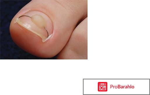 Грибок ногтей лечение препараты недорогие но эффективные обман