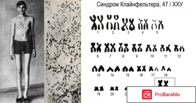 Синдром клайнфельтера фото 