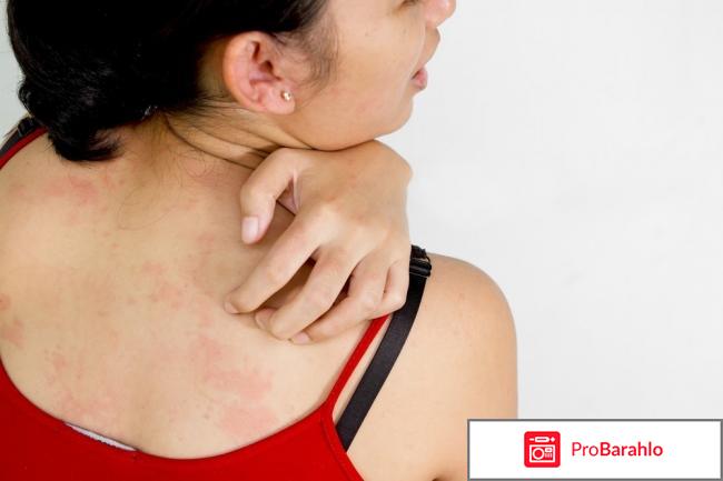 Хроническая идиопатическая крапивница — Причины отрицательные отзывы