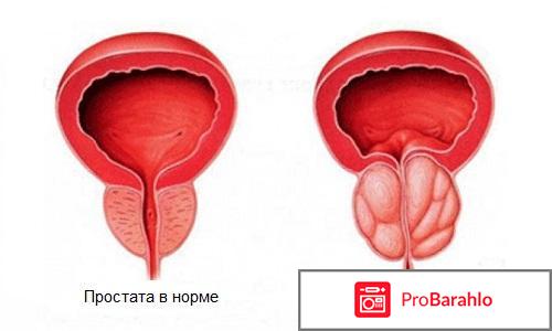 Дуодарт отзывы кто лечился отрицательные отзывы