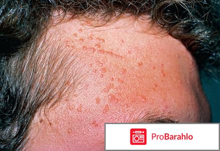 Клареол гель лекарство от папиллом фото