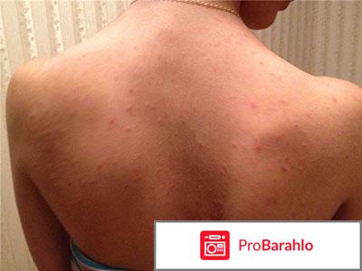Высыпания на спине 