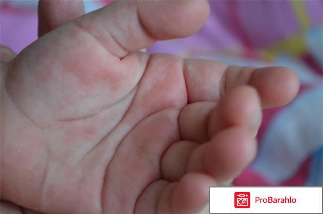 Сыпь на ладошках и ступнях у ребенка 