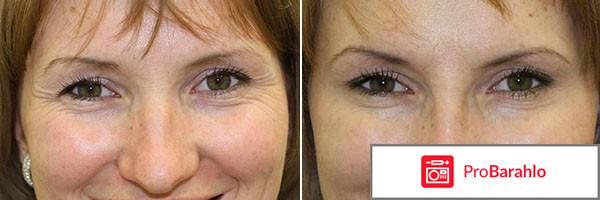 Диспорт фото до и после фото