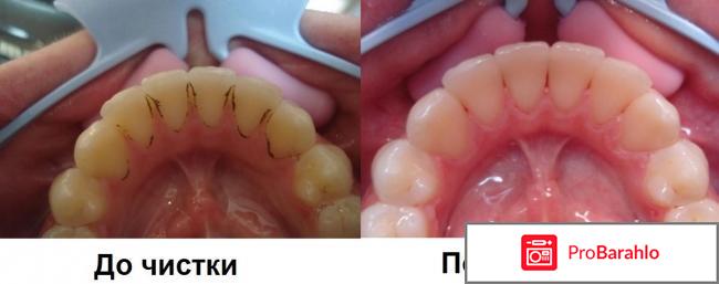 Снятие зубных отложений ультразвуком 