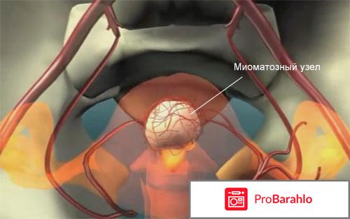 Миоматозный узел 