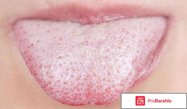 Пятна на языке у взрослых и детей, причины отрицательные отзывы