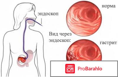 Диета при гастрите 