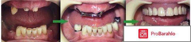 Имплантация зубов отрицательные отзывы