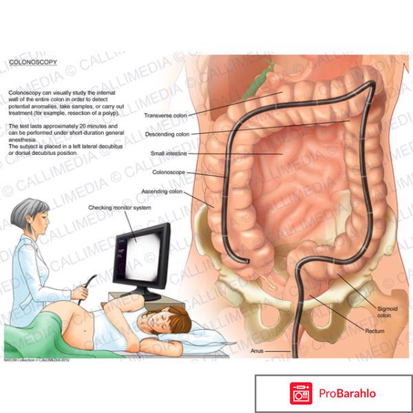 Колоноскопия кишечника под наркозом в спб отзывы обман