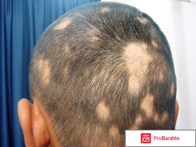 Миноксидил (Minoxidil) фото