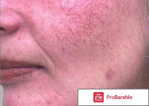 Сосуды на лице отрицательные отзывы