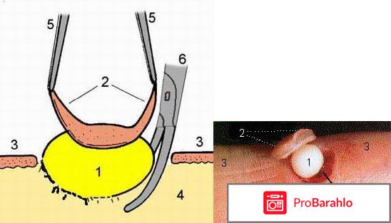 Удаление липомы отзывы 