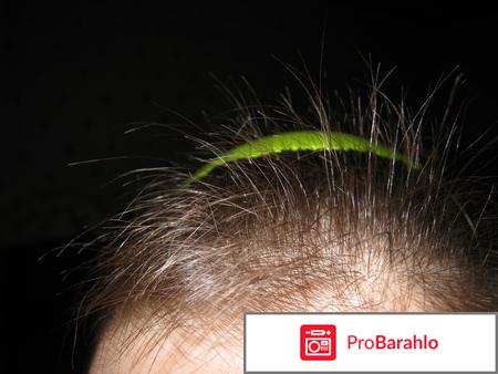 Дарсонваль 199 отзывы 