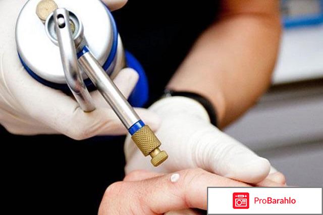 Удаление папиллом жидким азотом последствия обман