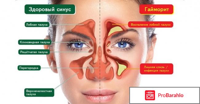 Прокол гайморита отрицательные отзывы