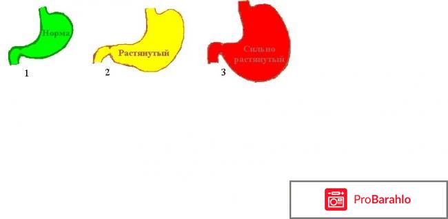 Как уменьшить объем желудка чтобы меньше есть 