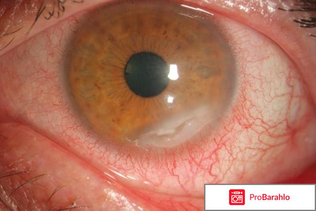 Актипол глазные капли инструкция цена отзывы отрицательные отзывы