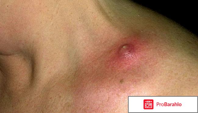 Фуцидин мазь инструкция по применению цена отзывы отрицательные отзывы