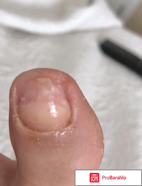 Лоцерил лак от грибка ногтей отзывы цена реальные отзывы