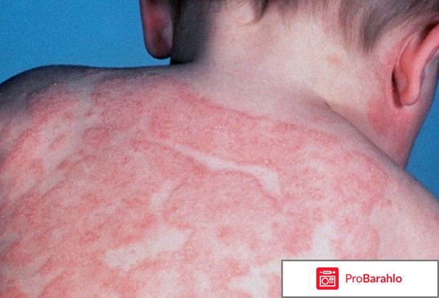 Атопический дерматит 