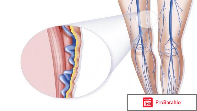 Крем ЗДОРОВ от варикоза реальные отзывы
