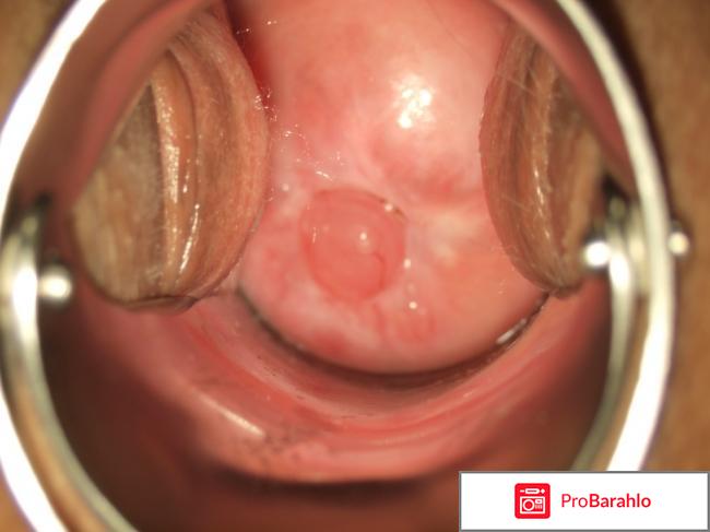 Полипэктомия матки обман
