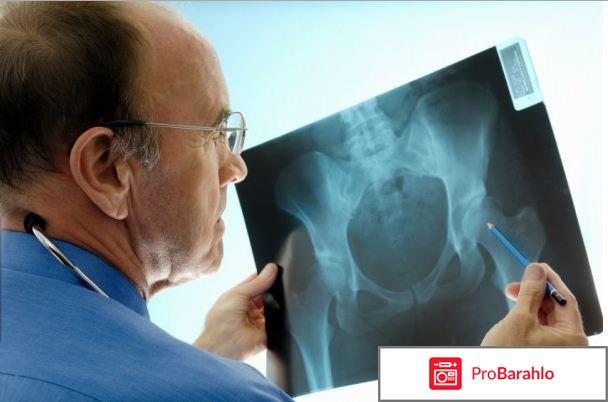 Профилактика остеопороза реальные отзывы