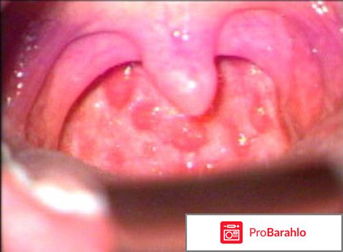 Ларингит симптомы лечение 