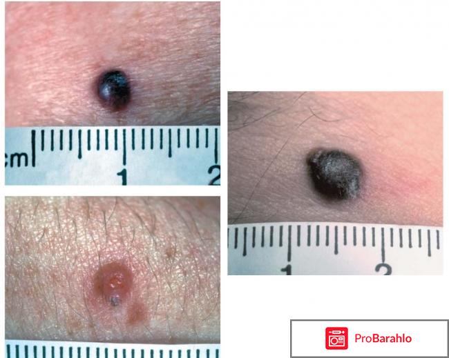 Отзывы людей больных меланомой обман