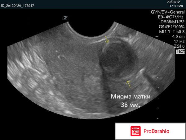 Миома отрицательные отзывы