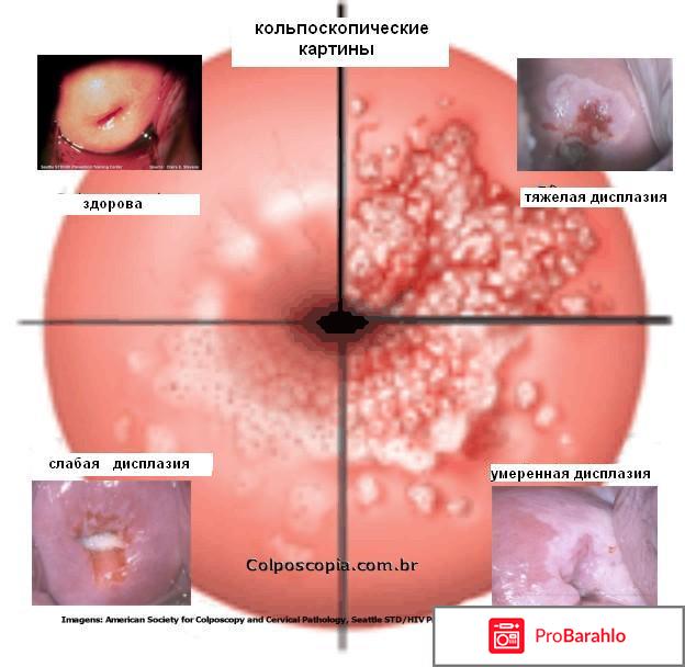 Кольпоскопия шейки матки обман