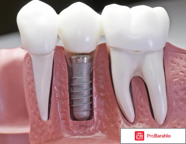 Зубной имплант 